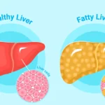 Silent-symptoms-of-fatty-liver-disease