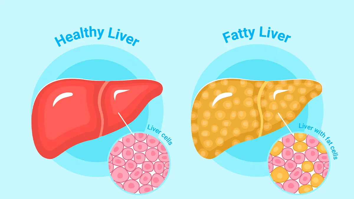 Silent-symptoms-of-fatty-liver-disease